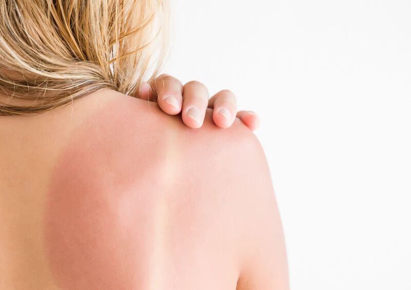 Eine Frau mit einem Sonnenbrand auf dem Rücken