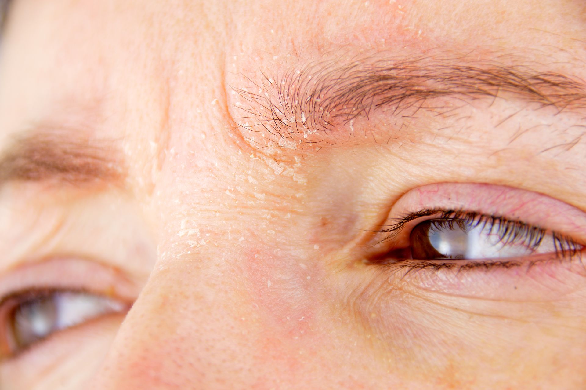 Trockene Haut Zwischen Den Augenbrauen www.medipharma.de