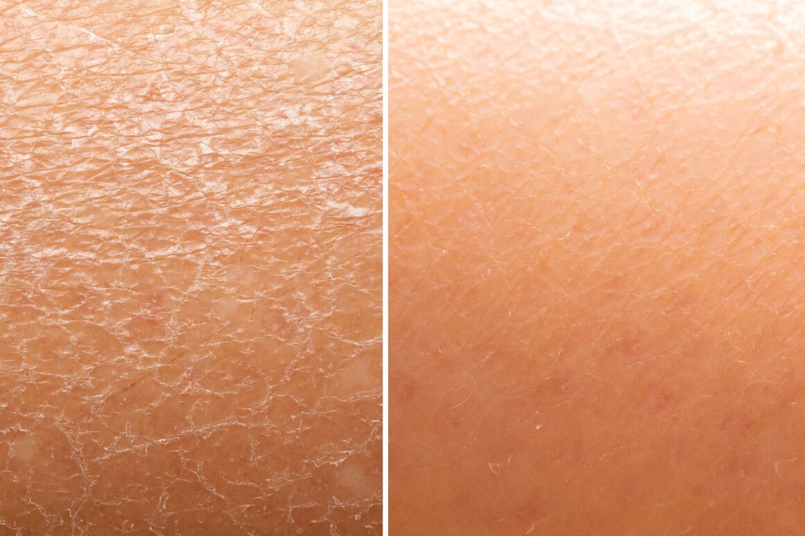 Trockene Haut vs. normale Haut