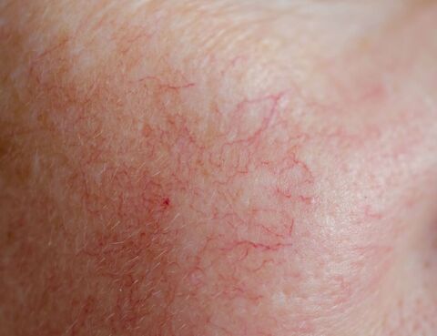 Gerötete Haut im Gesicht