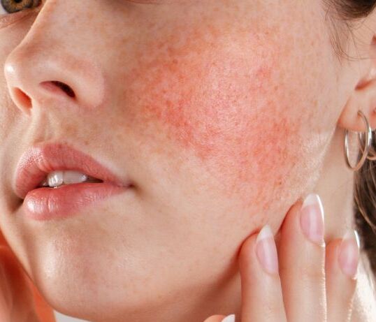 Frau mit geröteter Haut im Gesicht 