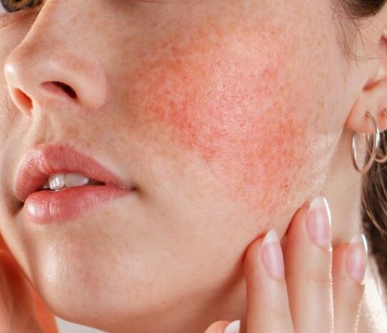 Frau mit geröteter Haut im Gesicht 